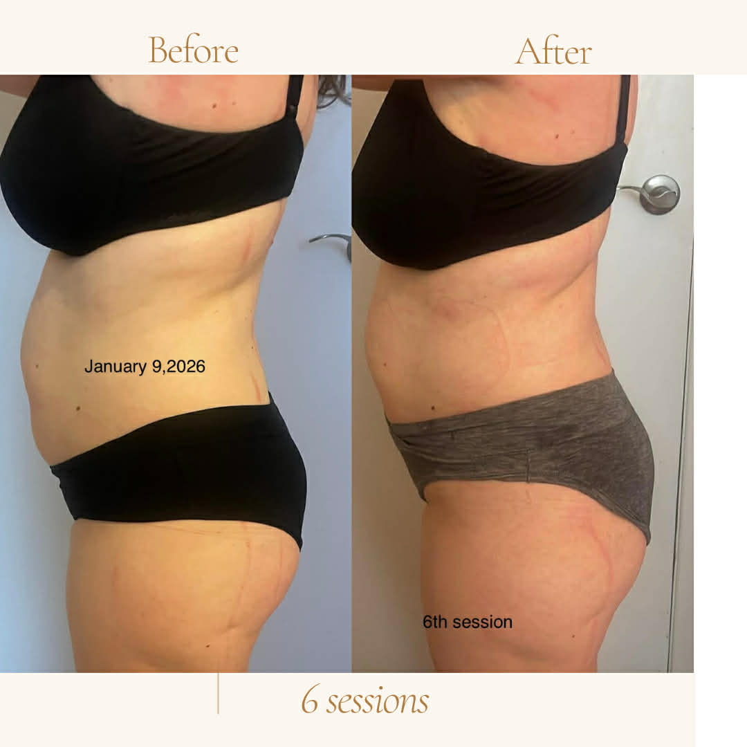 Before and after body contouring - side view, 6 sessions